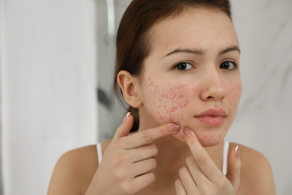 Young woman with acne examining her facial skin closely, concern evident in her expression.